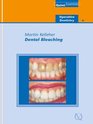 cover image of Dental Bleaching